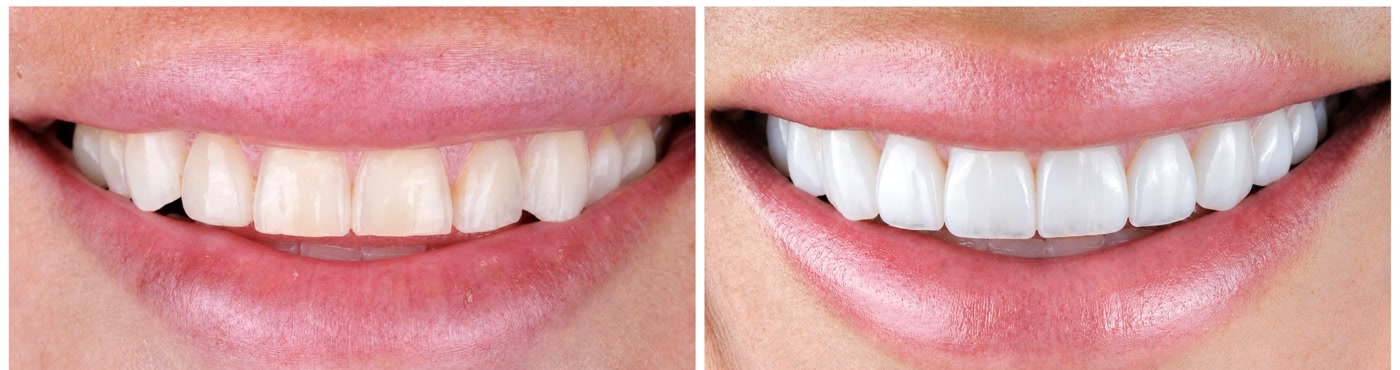 Her smile — before and after