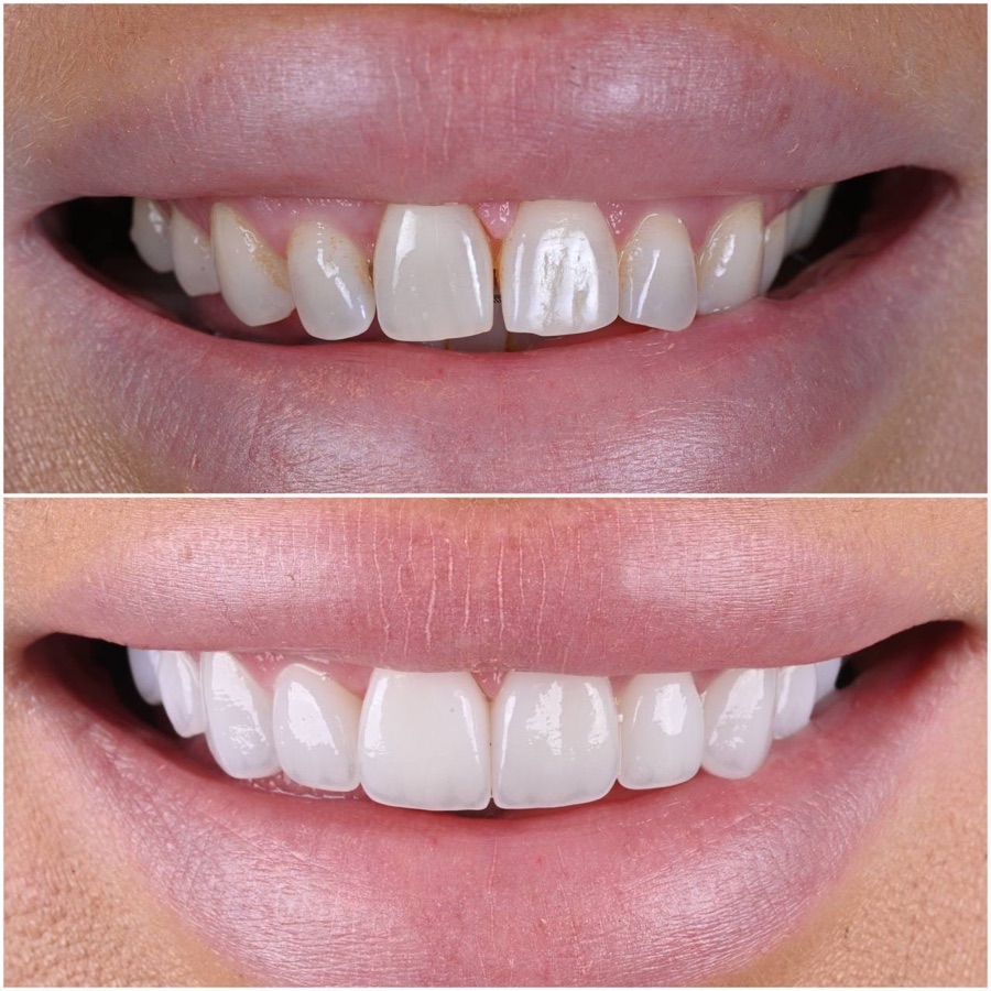 Before and after — shape and shade