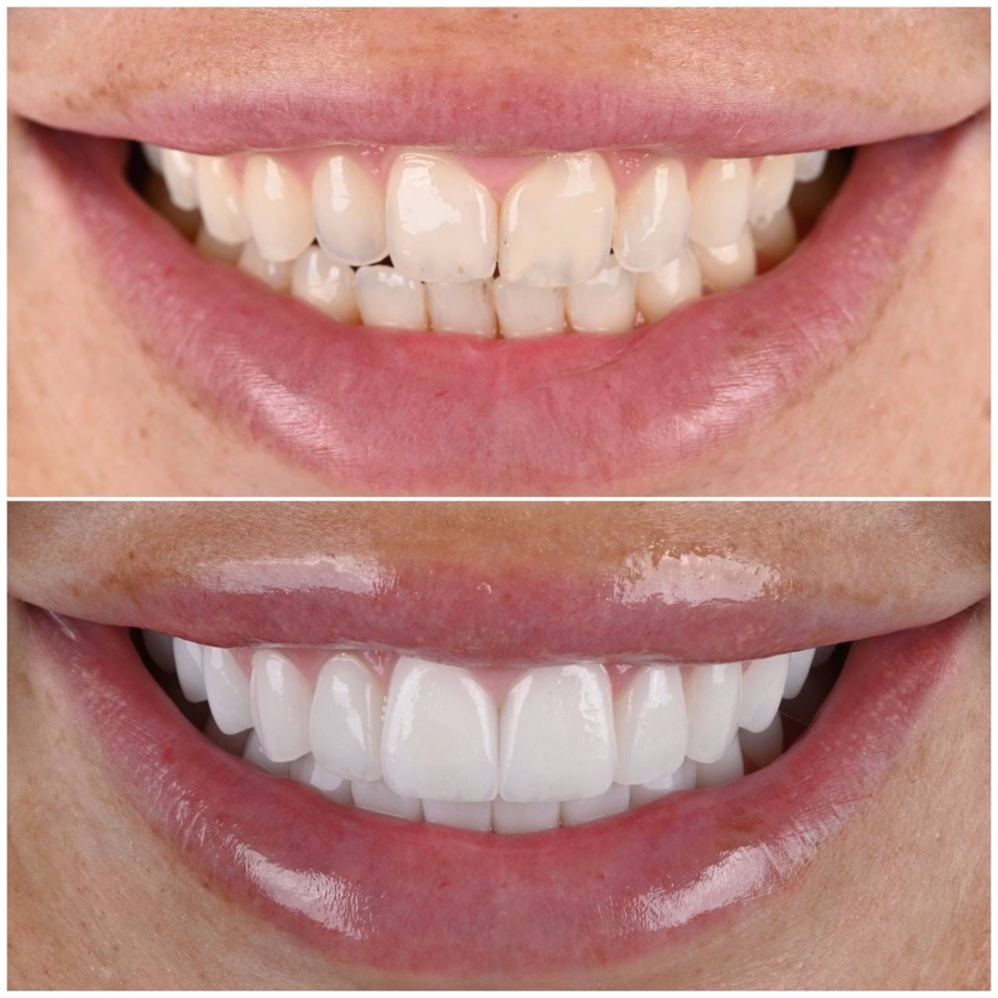 Before and after — alignment