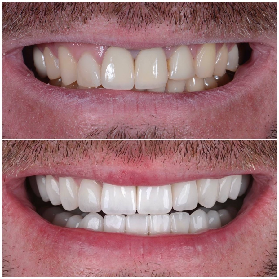 Before and after — whitening and shape