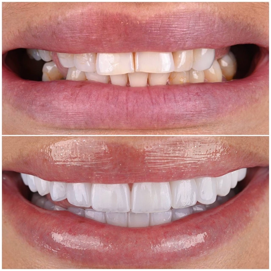 Before and after — veneers