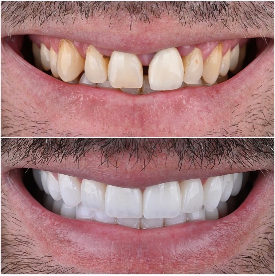 Before and after — shape correction