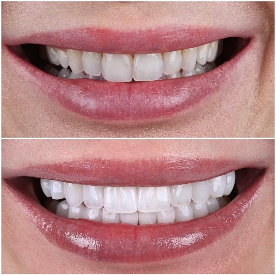 Before and after — aesthetic refresh